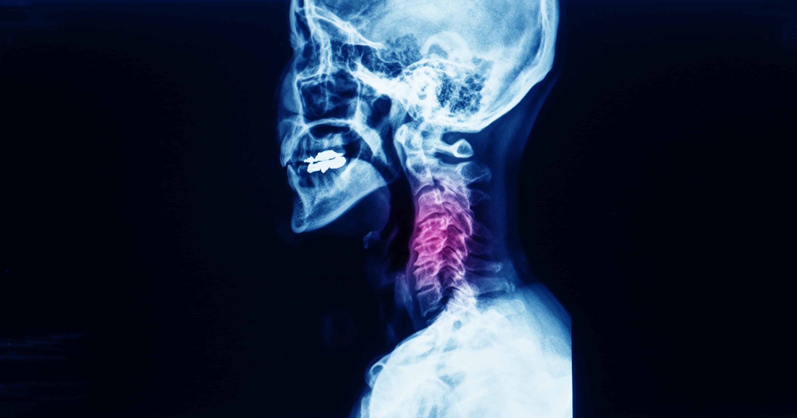 Study: Cannabis Users Use Less Opioids When Recovering from Neck Fusion Surgery